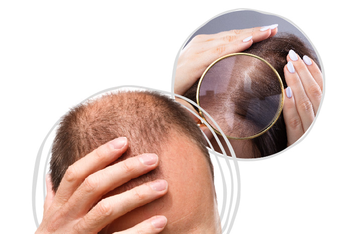 Tips | Tips on managing dandruff and hair loss | NTUC FairPrice